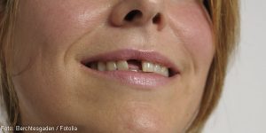 Zahnlücke und Implantat