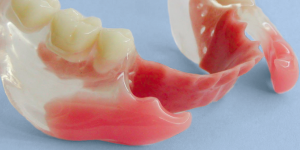 Bioverfträgliche Zahnersatzlösung bei mehreren fehlenden Zähnen