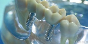 Implantate für mehrere Zähne