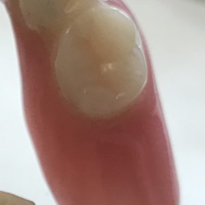 Provisorium aus Kunststoff