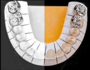 Zahnersatz für einzelne Zähne