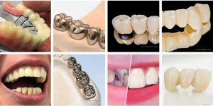 Lösungen für Zahnbrücken