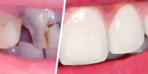 Vergleich vor und nach dem Einsetzen einer Zahnbrücke