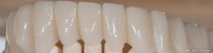 Zahnbrücke aus Keramik
