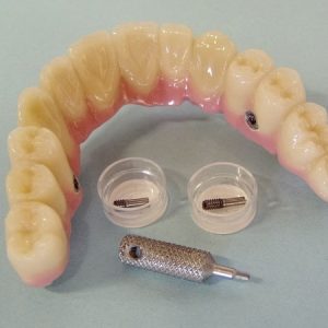 Zahnprothese auf Implantat